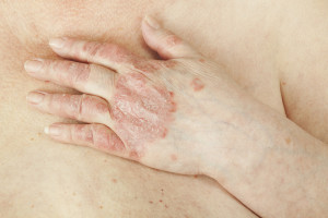 skin health - eczema