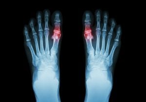 gout - joint health